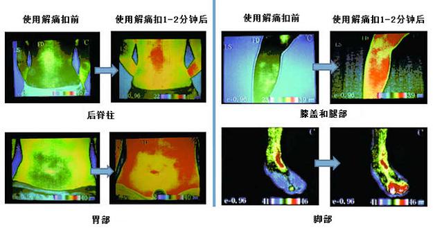 Infrared images of Back Spine, Stomach, Foot, and Knee and Leg<br />
areas before and after PainEze - Esmo Technologies
